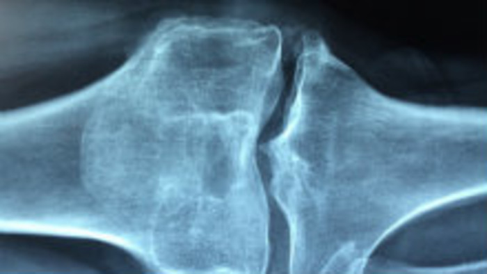 Osteoporóza u detí