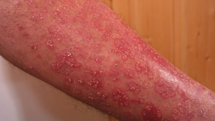 Kožné ochorenie psoriáza