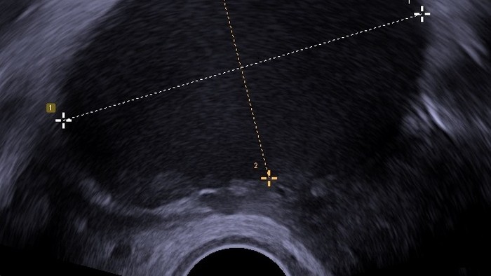 Endometrióza