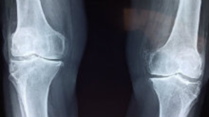 Osteoporóza sa týka i detí 