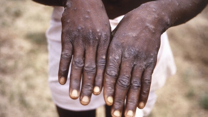 Chief hygienist issues regulation on monkeypox 