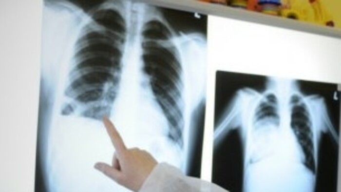 The much needed improvements in tuberculosis treatment