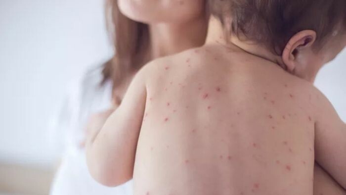 Public Health Authority: measles confirmed in 16-month-old child from Bratislava
