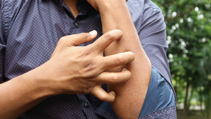 Uštipnutie hmyzom a alergická reakcia | O zdraví