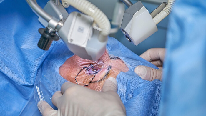 Operácia sivého zákalu pomocou femtosekundového laseru