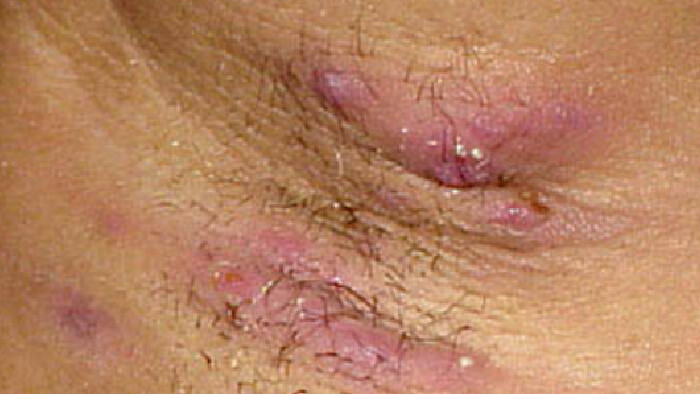 Čo je to Hidradenitis suppurativa?