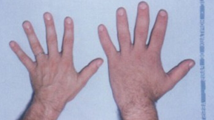 S endokrinológom MUDr. Petrom Vaňugom o Akromegálii