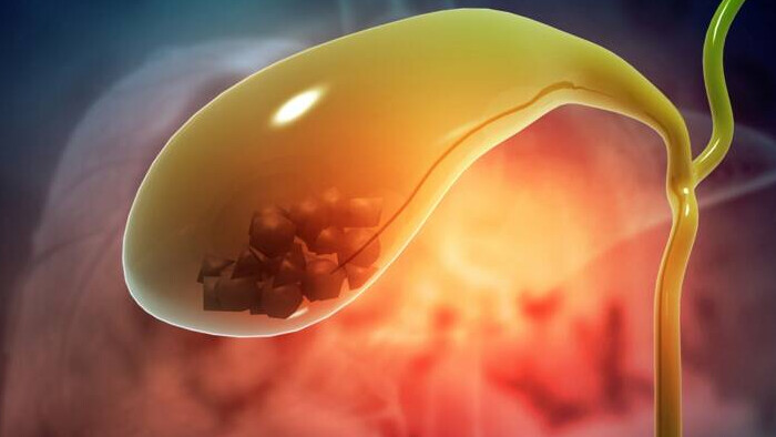 Čo je príčinou vzniku žlčových kameňov a bolestivých kolík?