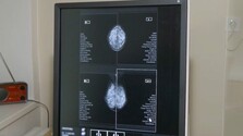 Mamografia dokáže odhaliť aj malé nádory bez príznakov, na skríning však chodí len nízke percento žien