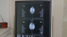 Mamografia dokáže odhaliť aj malé nádory bez príznakov, na skríning však chodí len nízke percento žien
