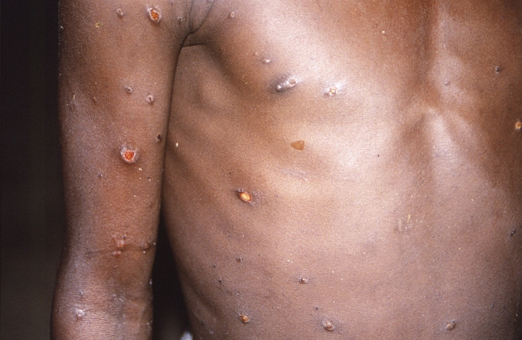 Monkeypox407649871488_TASR.jpg