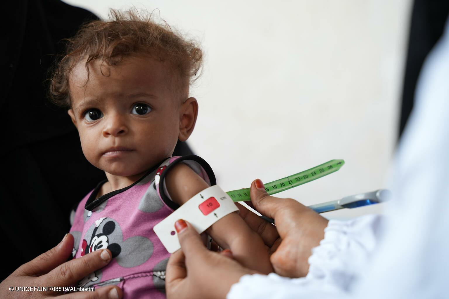 Zbierka Modrý gombík UNICEF 2025 pomôže podvýživeným deťom